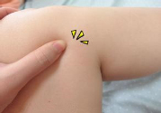 小腿水腫是什么原因引起的？教你輕松解決之道