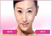 美白針真的有效嗎？美白針的危害有哪些？