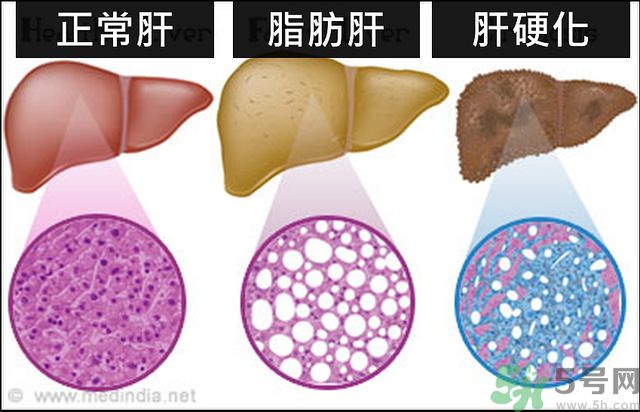 得了脂肪肝該怎么治？脂肪肝對人體危害有多大？