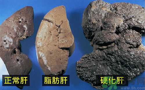 得了脂肪肝該怎么治？脂肪肝對人體危害有多大？