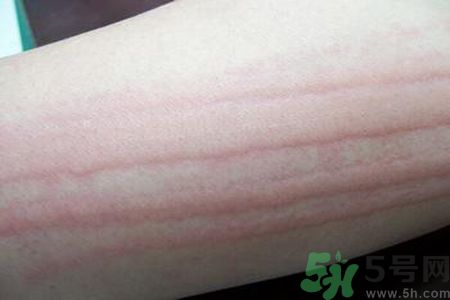 蕁麻疹會不會傳染？蕁麻疹怎么治才能好？