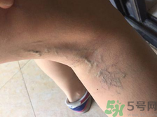 40歲女性小腿靜脈曲張?jiān)趺崔k？