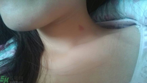 種草莓吻痕是什么意思？吻痕是怎么弄出來(lái)的？