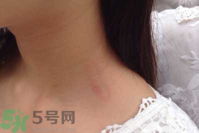 種草莓吻痕是什么意思？吻痕是怎么弄出來(lái)的？