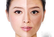 激光美白有用嗎？激光美白可以維持多久？