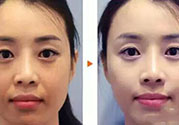 激光美白多少錢？激光美白價(jià)格