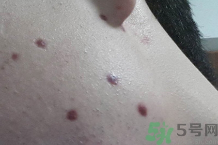 激光點痣后可以洗臉嗎？激光點痣后需要注意什么？