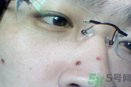 激光點(diǎn)痣后可以洗臉嗎？激光點(diǎn)痣后需要注意什么？