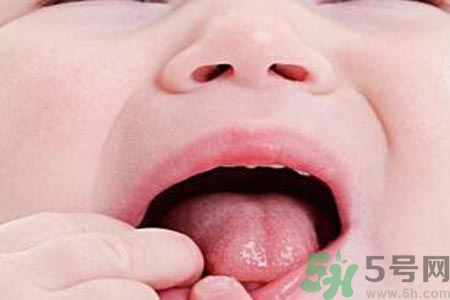 寶寶口腔潰瘍怎么辦？治療寶寶口腔潰瘍方法有什么？