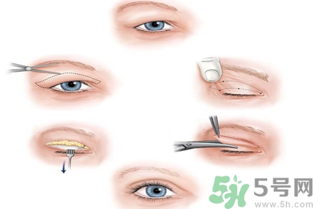 割雙眼皮分哪幾種？割雙眼皮需要多少錢？