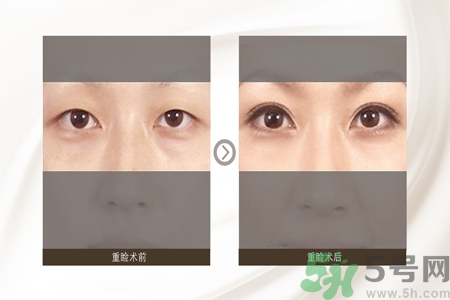 割雙眼皮分哪幾種？割雙眼皮需要多少錢？