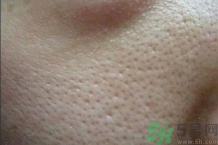 皮膚毛孔粗大原因有哪些？如何預(yù)防皮膚毛孔粗大？