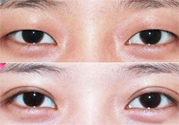 割雙眼皮分哪幾種？割雙眼皮需要多少錢？