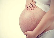 什么是妊娠紋？妊娠紋什么時(shí)候開始長？