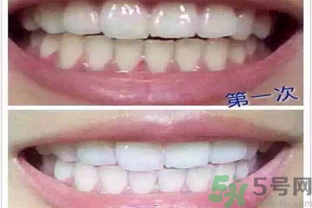 冷光美白牙齒的價(jià)格是多少？做冷光美白牙齒需要多少錢？