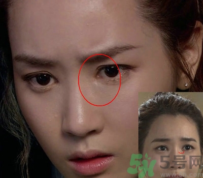 開眼角多少錢？開眼角有什么危害？