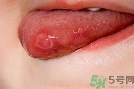 舌頭長(zhǎng)泡怎么辦？舌頭長(zhǎng)泡的原因？