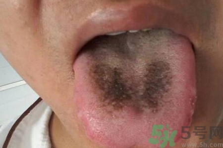 舌頭發(fā)黑怎么回事？舌頭發(fā)黑怎么辦？