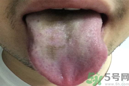 舌頭發(fā)黑怎么回事？舌頭發(fā)黑怎么辦？