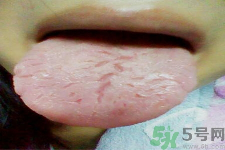 舌頭上有裂紋是怎么辦？舌頭上有裂紋是什么原因？