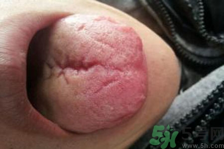 舌頭上有裂紋是怎么辦？舌頭上有裂紋是什么原因？