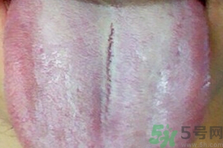 舌頭發(fā)白是什么原因？舌苔發(fā)白是怎么辦？