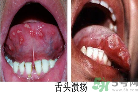 舌頭潰瘍怎么辦？舌頭潰瘍的原因？