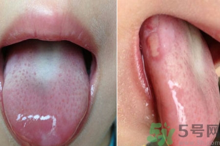 舌頭潰瘍怎么辦？舌頭潰瘍的原因？