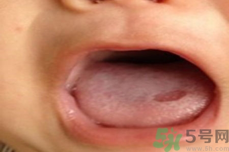 舌頭潰瘍?cè)趺崔k？舌頭潰瘍的原因？