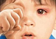 寶寶得了紅眼病怎么辦？寶寶得了紅眼病怎么治？