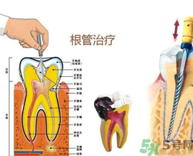 什么是根管治療？為什么牙齒疼要做根管治療？