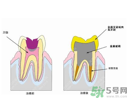 什么是根管治療？為什么牙齒疼要做根管治療？