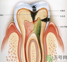 什么是根管治療？為什么牙齒疼要做根管治療？