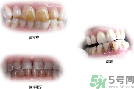 四環(huán)素牙是什么？四環(huán)素牙是怎么形成的？