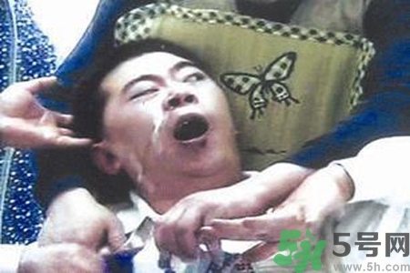 癲癇的典型癥狀有哪些？癲癇是什么？