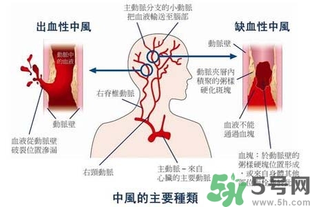 腦中風(fēng)是什么？腦中風(fēng)的癥狀？