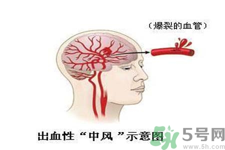 腦中風(fēng)的護(hù)理措施？腦中風(fēng)的飲食護(hù)理？