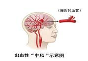 腦中風(fēng)的發(fā)病因素？腦中風(fēng)的并發(fā)癥有哪些 ？