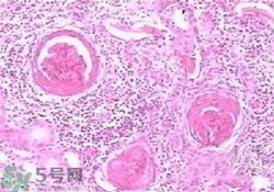 慢性腎炎能治好嗎？慢性腎炎能活多久？