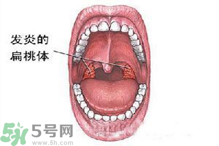 慢性咽炎是什么？慢性咽炎的癥狀有哪些？