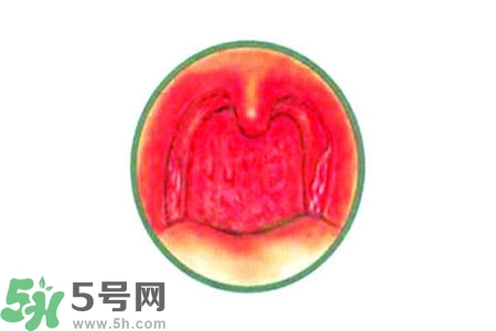 慢性咽炎的治療方法？慢性咽炎的藥物治療？