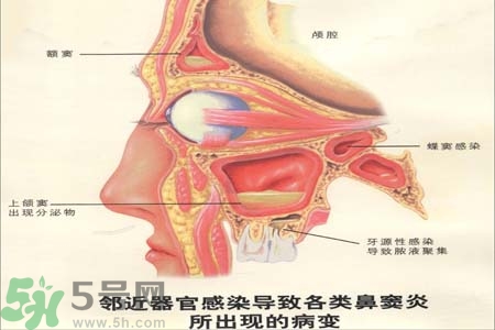 鼻竇炎是什么？鼻竇炎的癥狀有哪些？