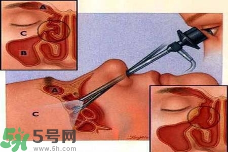 鼻竇炎的高發(fā)人群？如何預(yù)防鼻竇炎？