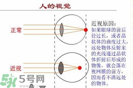 近視眼的發(fā)病因素？近視眼的并發(fā)癥有哪些？