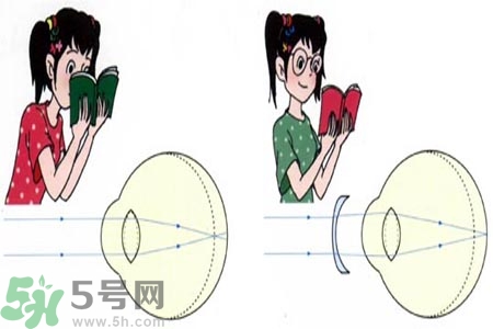 近視眼的發(fā)病因素？近視眼的并發(fā)癥有哪些？