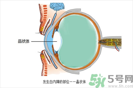 白內(nèi)障的護(hù)理措施是什么？白內(nèi)障的飲食護(hù)理有哪些？