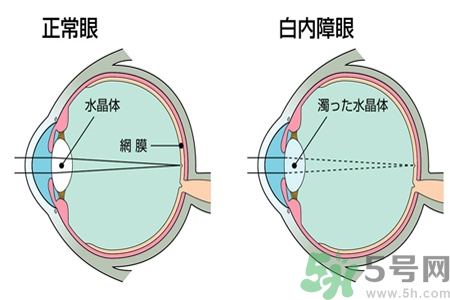 白內(nèi)障治療方法是什么？白內(nèi)障可以用什么藥物治療？
