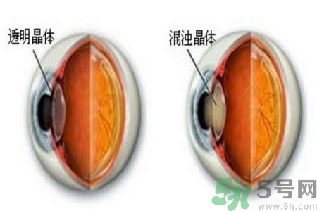 白內(nèi)障治療方法是什么？白內(nèi)障可以用什么藥物治療？
