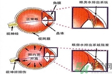 青光眼的發(fā)病因素是什么？青光眼的并發(fā)癥有哪些？