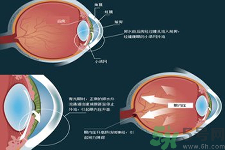 青光眼的高發(fā)人群有哪些？如何預(yù)防青光眼？
